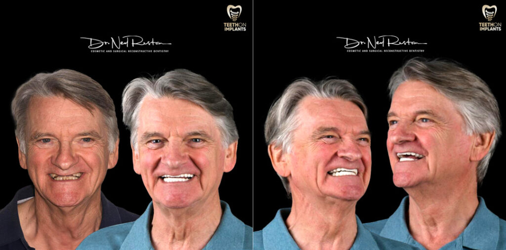 Teeth on Implants Before and Afters