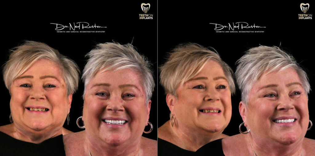 Teeth on Implants Before and Afters