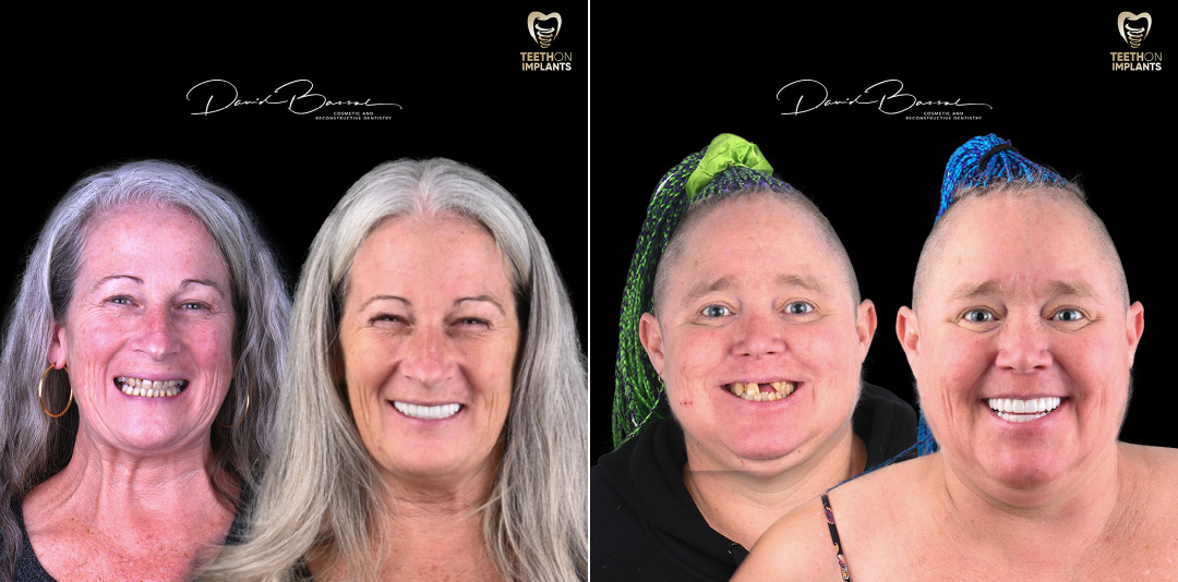 Teeth-on-Implants-Dr-David-Bassal-Patients-Before-and-Afters-2024-01