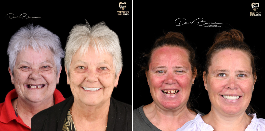 Teeth-on-Implants-Dr-David-Bassal-Patients-Before-and-Afters-2024-02
