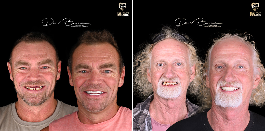 Teeth-on-Implants-Dr-David-Bassal-Patients-Before-and-Afters-2024-03