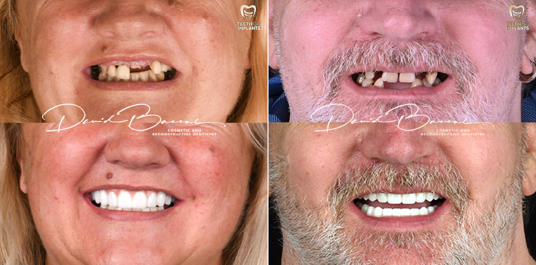 Teeth-on-Implants-Dr-David-Bassal-Patients-Before-and-Afters-2024-04