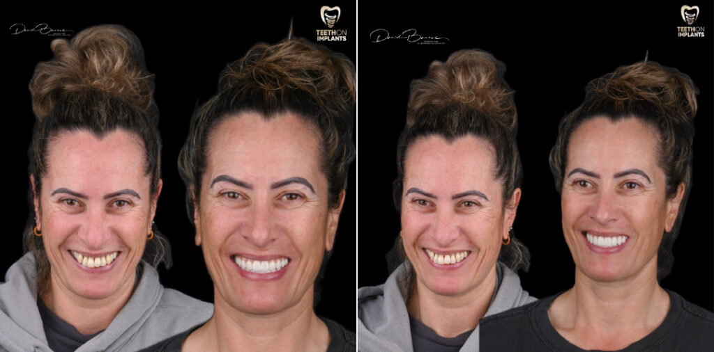 Teeth-on-Implants-Dr-David-Bassal-Patients-Before-and-Afters-2024-05
