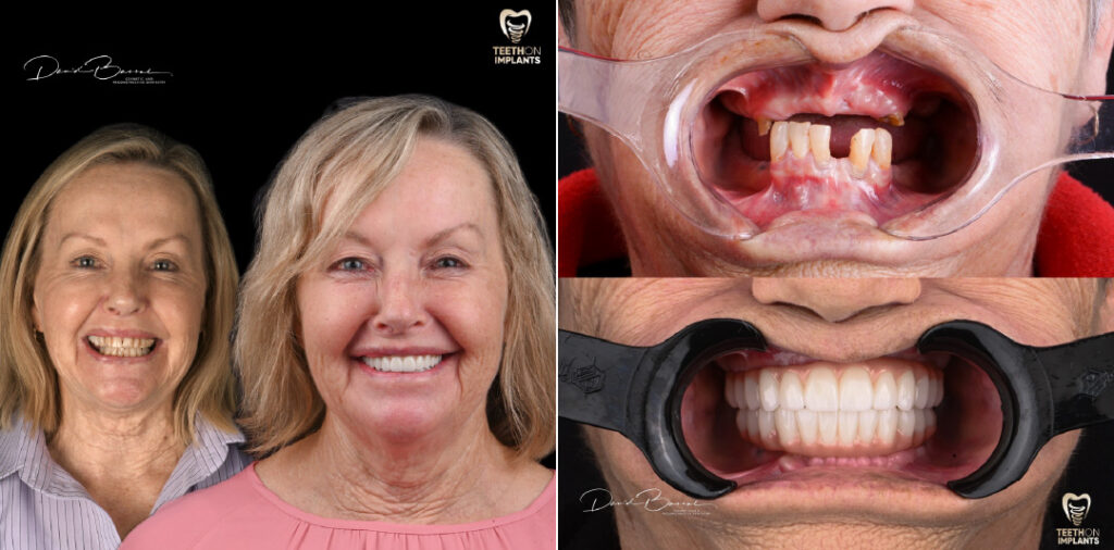 Teeth-on-Implants-Dr-David-Bassal-Patients-Before-and-Afters-2024-06