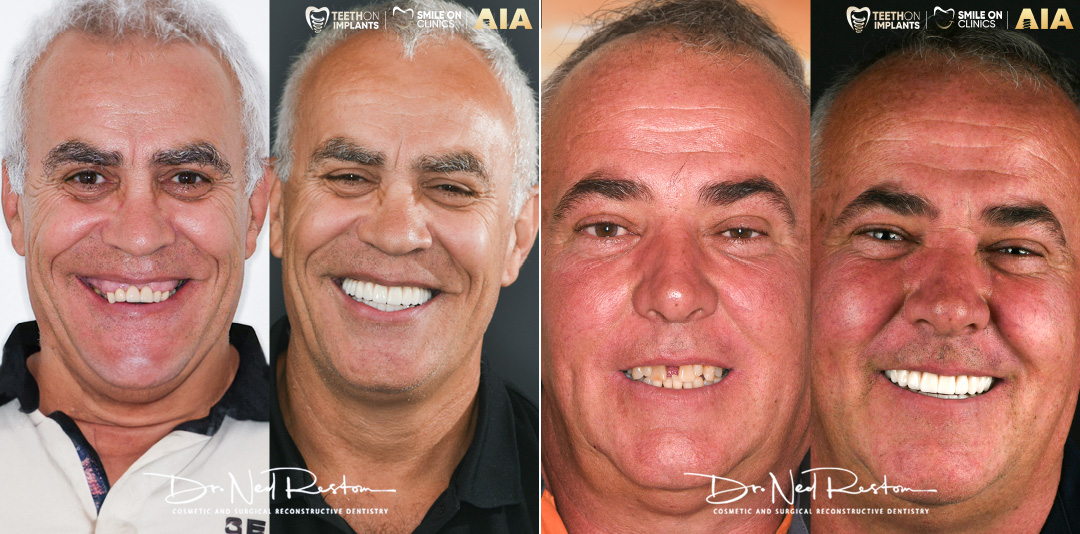 Teeth-on-Implants-Dr-Ned-Restom-Patients-Before-and-Afters-2024-03