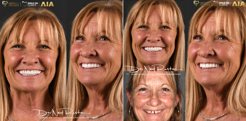 Teeth-on-Implants-Dr-Ned-Restom-Patients-Before-and-Afters-2024-05