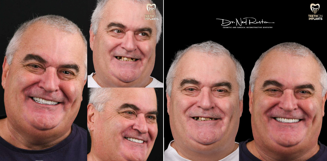 Teeth-on-Implants-Dr-Ned-Restom-Patients-Before-and-Afters-2024-09